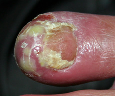 Nail Disorder